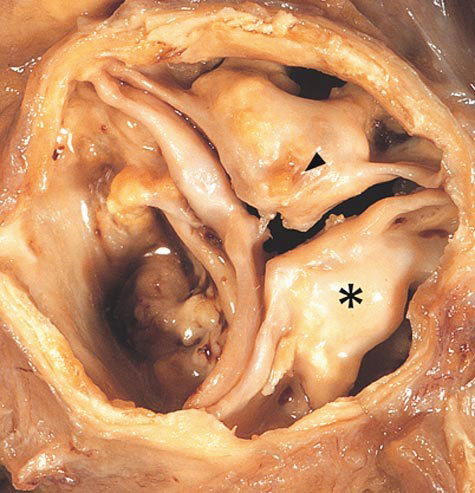 Fig. 1. Forkalket aortaklaff